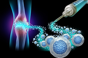 Advances in Hip and Knee Arthritis Treatments: What's New?